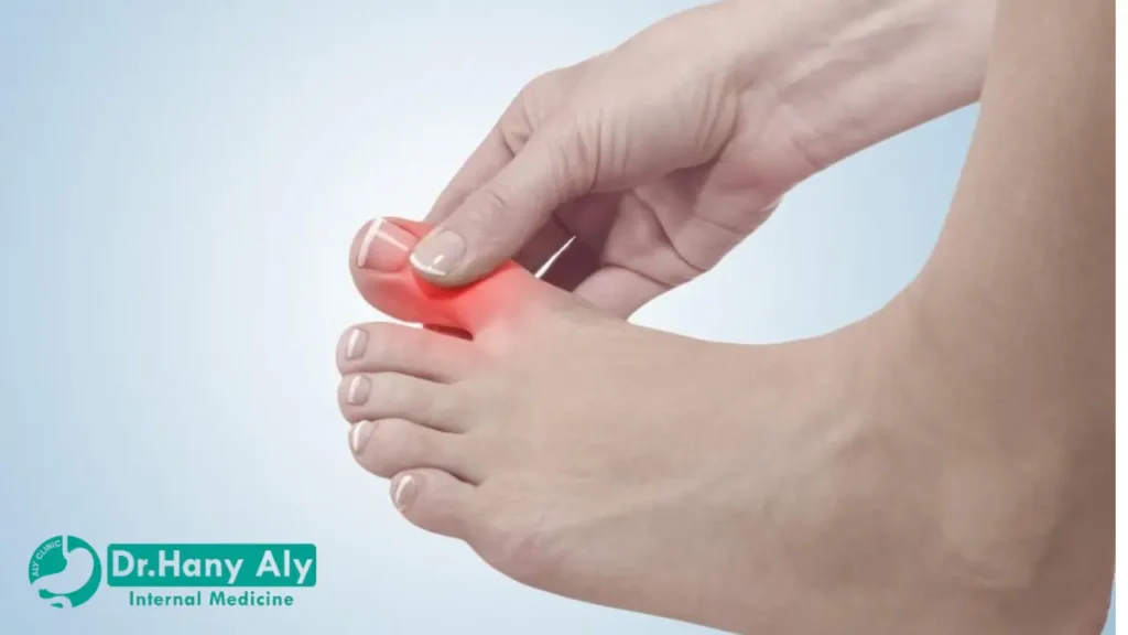 أعراض النقرس عند النساء