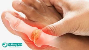 أعراض النقرس عند النساء