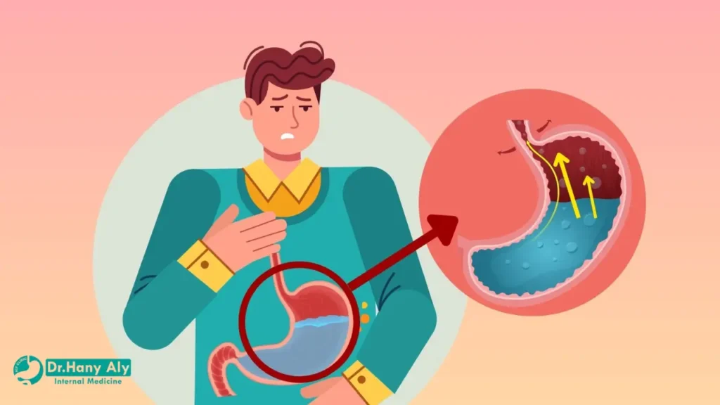 افضل دكتور لعلاج ارتجاع المرئ