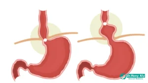 الفرق بين ارتجاع المريء وفتق الحجاب الحاجز