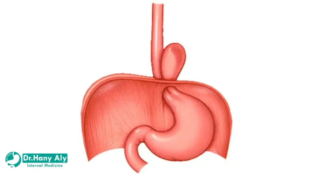 الفرق بين ارتجاع المريء وفتق الحجاب الحاجز