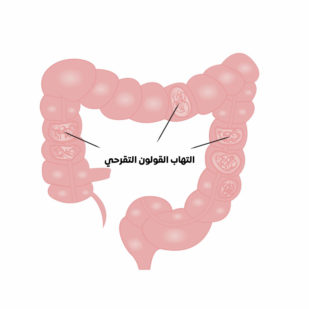 القولون التقرحي